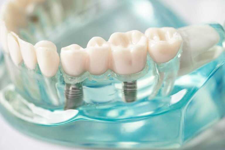 Zasady zakładania implantów – czy to rozwiązanie dla każdego?